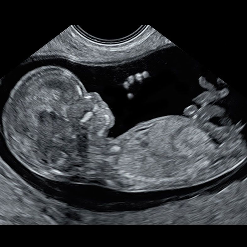 Early Fetal Scan at 12-weeks. Educational image from London Pregnancy Clinic