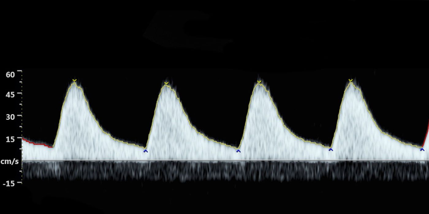Doppler Scan spectrogram image that shows flow velocity (cm/s) against time. 