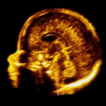 Fetal 3D Neurosonography: Corpus callosum & vermis