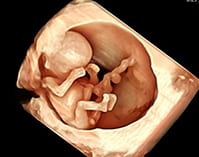 Early-Fetal-Scan