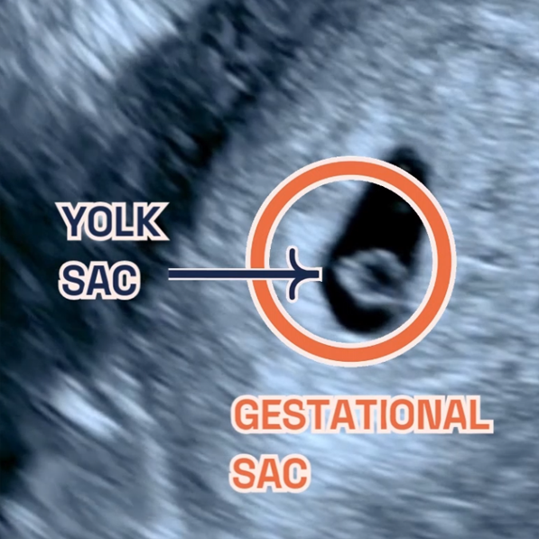 Image showing what would an ultrasound show at 5 weeks of pregnancy. It shows an Ultrasound image by London Pregnancy Clinic that shows the gestational sac and the newly developed yolk sac - for educational purpose.