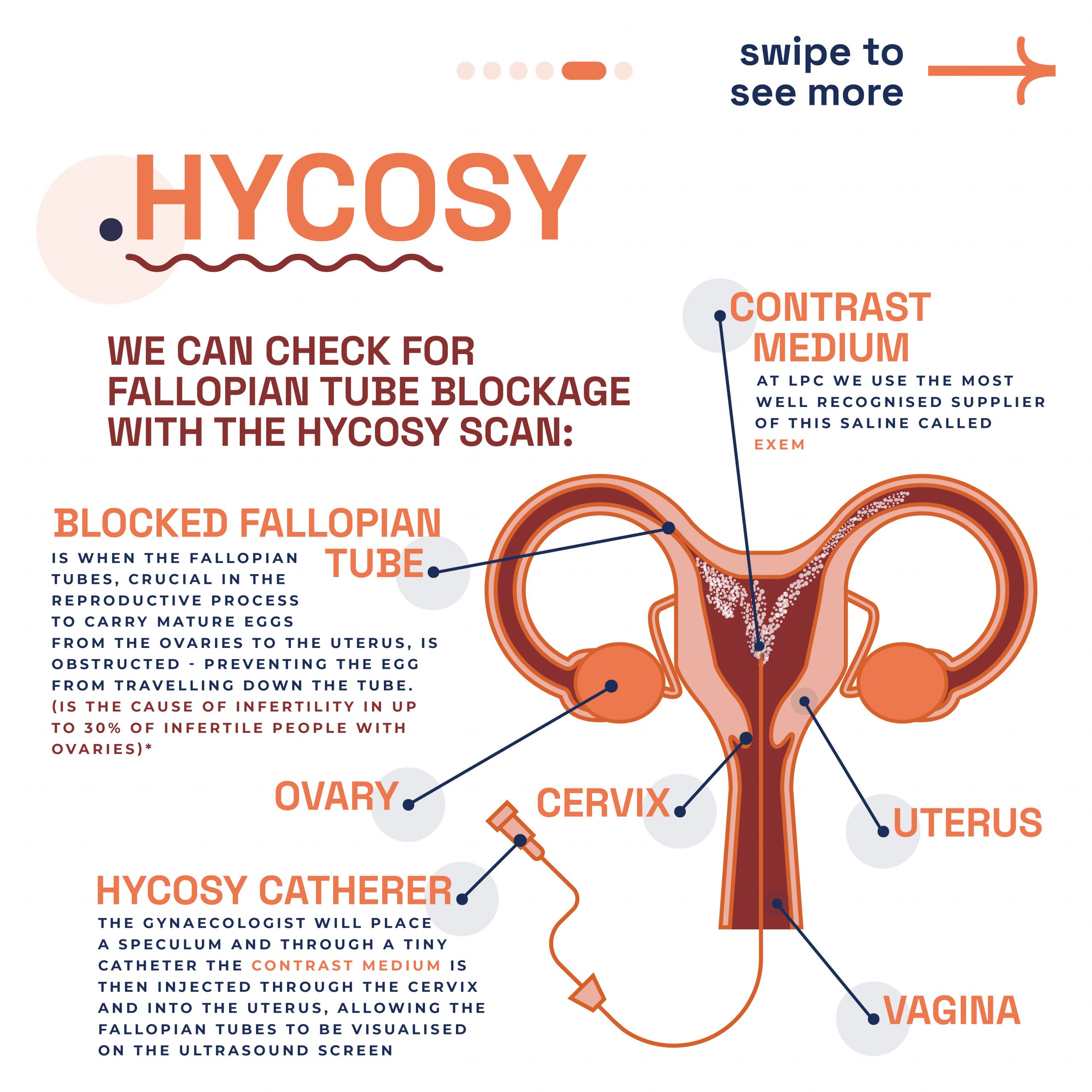 Explanation of the HYCOSY scan procedure for checking fallopian tube blockage, offered by London Pregnancy Clinic.